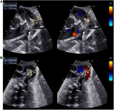A predictive model for patent ductus arteriosus seven days postpartum in preterm infants: an ultrasound-based assessment of ductus arteriosus intimal thickness within 24 h after birth
